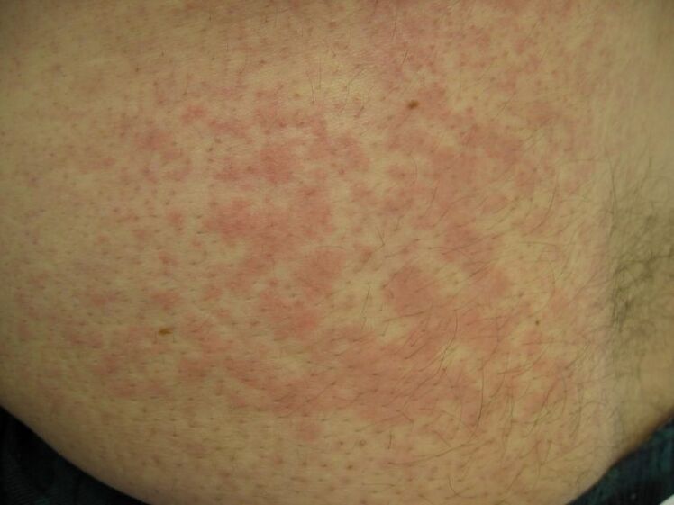 人体皮肤下的血吸虫引起荨麻疹